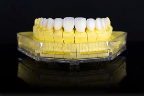 Răng sứ Orodent - ảnh 4 Răng sứ Orodent - ảnh 4