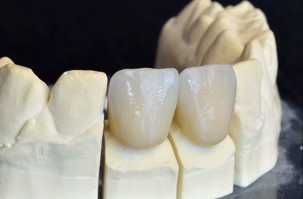 Răng sứ Venus - ảnh 2 Răng sứ Venus - ảnh 2