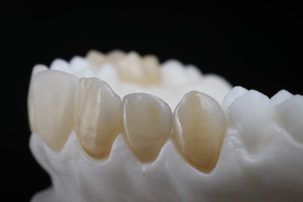 Răng sứ Venus - ảnh 3 Răng sứ Venus - ảnh 3