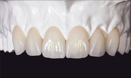 Răng sứ Zirconia - ảnh 1 Răng sứ Zirconia - ảnh 1