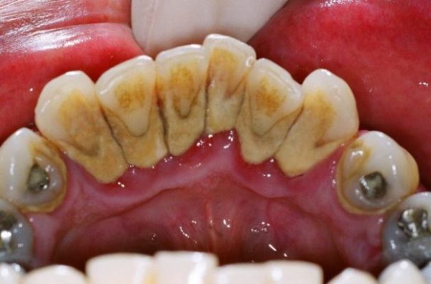 bao lâu lấy cao răng 1 lần - ảnh 1 bao lâu lấy cao răng 1 lần - ảnh 1