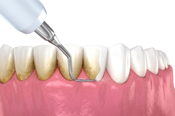 bao lâu lấy cao răng 1 lần - ảnh 2 bao lâu lấy cao răng 1 lần - ảnh 2