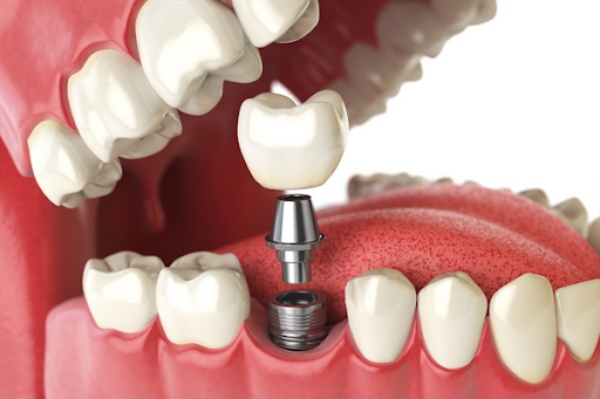 giá trồng răng giả - ảnh 1 giá trồng răng giả - ảnh 1