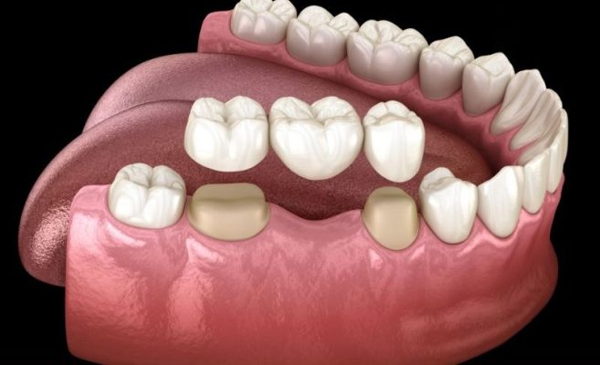 giá trồng răng giả - ảnh 3 giá trồng răng giả - ảnh 3