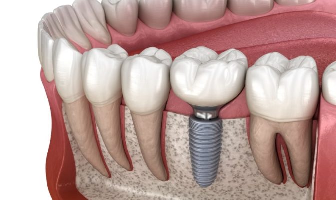 giá trồng răng giả - ảnh 4 giá trồng răng giả - ảnh 4