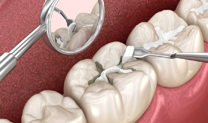 hàn răng giá bao nhiêu - ảnh 1 hàn răng giá bao nhiêu - ảnh 1