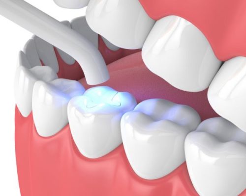 hàn răng ở đâu - ảnh 1 hàn răng ở đâu - ảnh 1