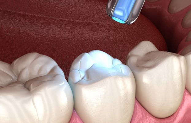 hàn răng ở đâu - ảnh 2 hàn răng ở đâu - ảnh 2