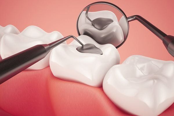 hàn răng sâu - ảnh 1 hàn răng sâu - ảnh 1