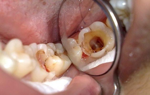 hàn răng sâu - ảnh 2 hàn răng sâu - ảnh 2