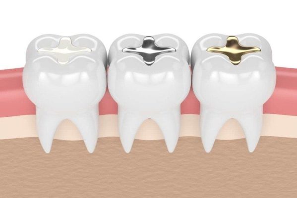 hàn răng sâu - ảnh 3 hàn răng sâu - ảnh 3