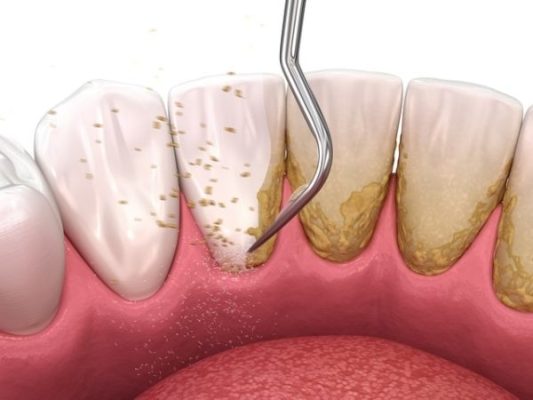 lấy cao răng có đau không - ảnh 1 lấy cao răng có đau không - ảnh 1