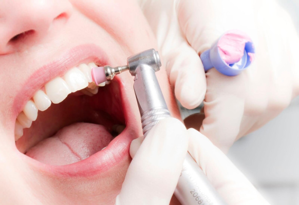 lấy cao răng có đau không - ảnh 3 lấy cao răng có đau không - ảnh 3
