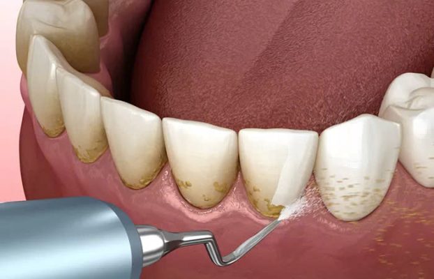 lấy cao răng giá bao nhiêu - ảnh 1 lấy cao răng giá bao nhiêu - ảnh 1