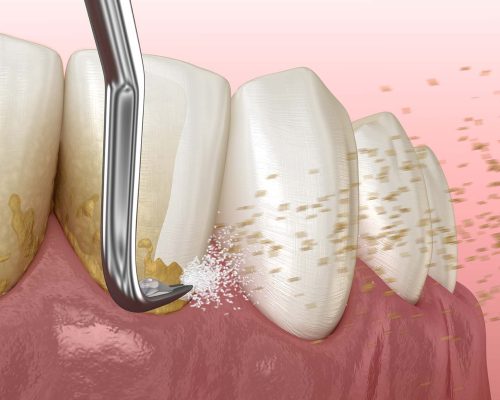 lấy cao răng ở đâu tốt - ảnh 1 lấy cao răng ở đâu tốt - ảnh 1