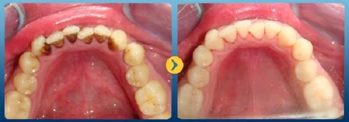 lấy cao răng ở đâu tốt - ảnh 3