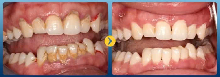 lấy cao răng ở đâu tốt - ảnh 4