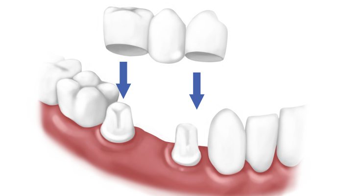 trồng răng có đau không - ảnh 2 trồng răng có đau không - ảnh 2