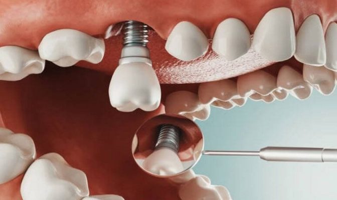 trồng răng có đau không - ảnh 3 trồng răng có đau không - ảnh 3