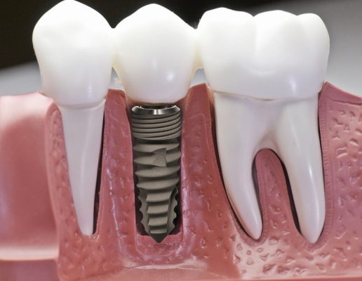 Trồng răng implant - ảnh 1 Trồng răng implant - ảnh 1