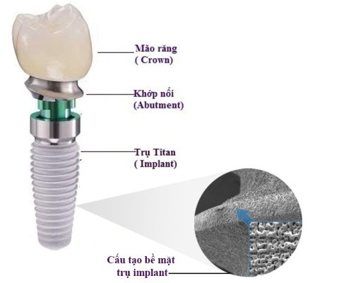 Trồng răng implant - ảnh 2 Trồng răng implant - ảnh 2