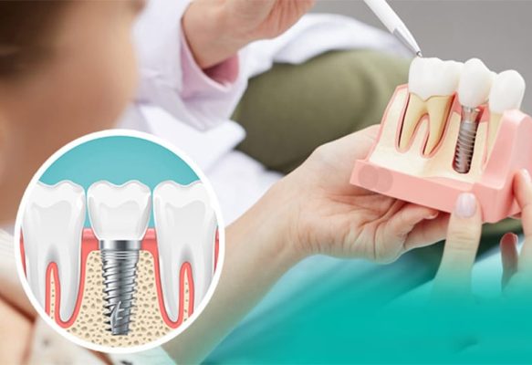 Trồng răng implant - ảnh 3 Trồng răng implant - ảnh 3