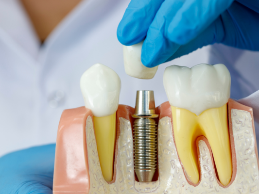 Trồng răng implant - ảnh 4 Trồng răng implant - ảnh 4