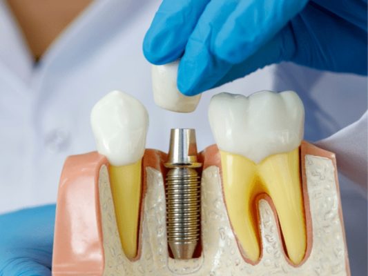 Trồng răng mất bao lâu? - ảnh 1 Trồng răng mất bao lâu? - ảnh 1