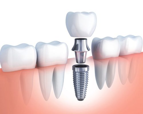 Trồng răng mất bao lâu? - ảnh 2 Trồng răng mất bao lâu? - ảnh 2