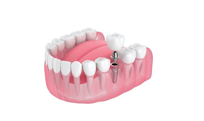 trồng răng ở đâu - ảnh 1 trồng răng ở đâu - ảnh 1