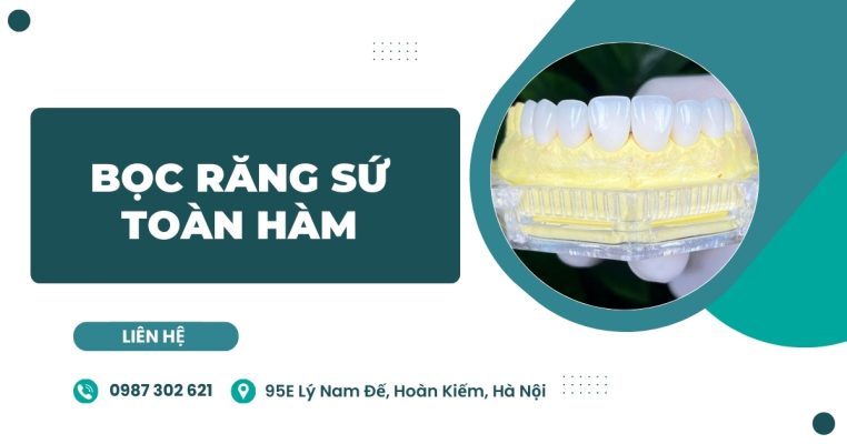 Bọc răng sứ toàn hàm