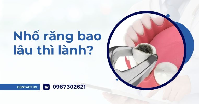 Nhổ răng bao lâu thì lành?