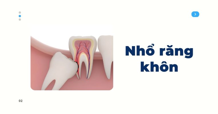nhổ răng khôn