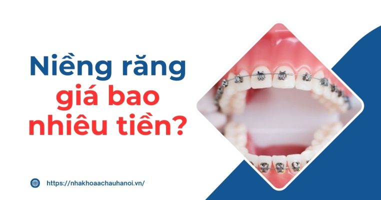 Niềng răng giá bao nhiêu tiền
