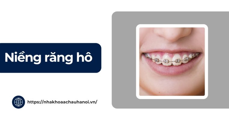 Niềng răng hô