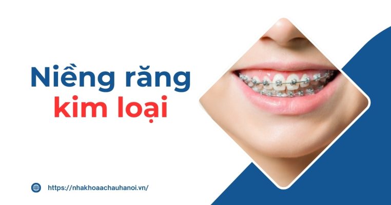 Niềng răng kim loại