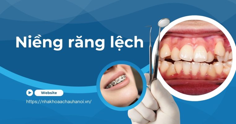 niềng răng lệch
