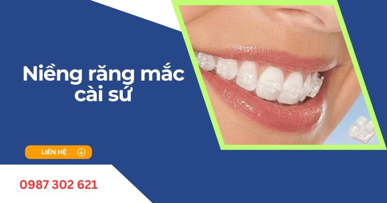 niềng răng mắc cài sứ