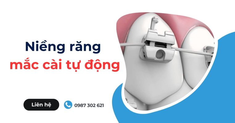 niềng răng mắc cài tự động