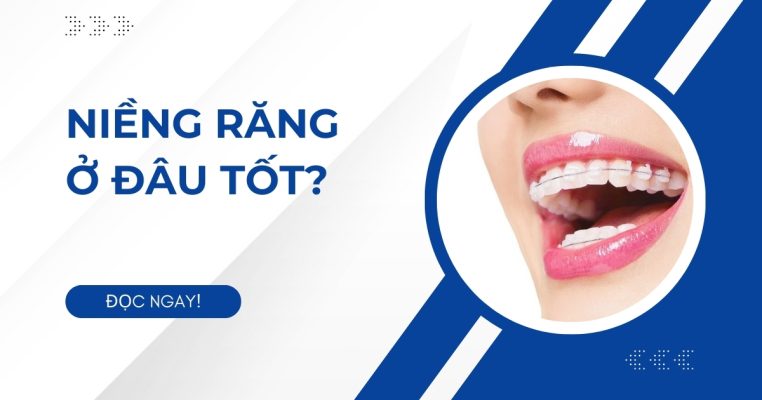 niềng răng ở đâu tốt