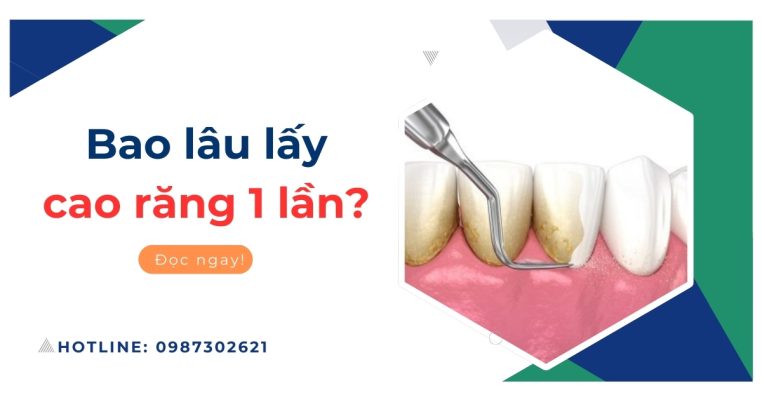 bao lâu lấy cao răng 1 lần