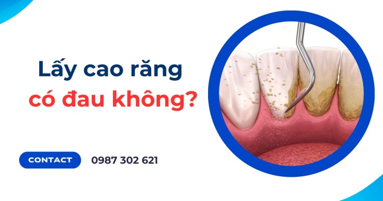 lấy cao răng có đau không