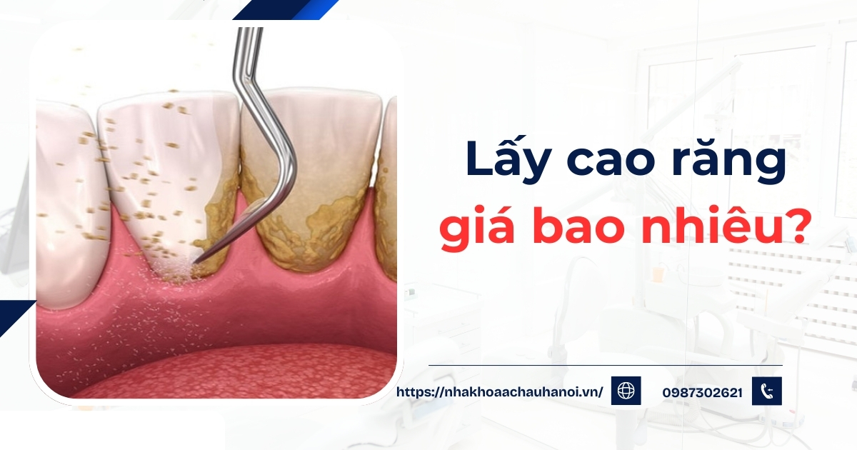 lấy cao răng giá bao nhiêu