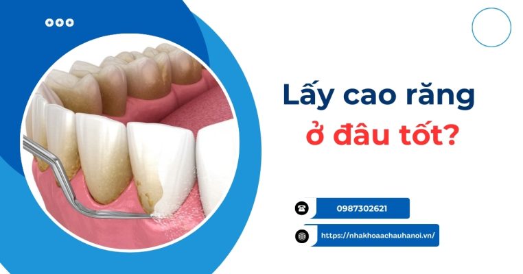 lấy cao răng ở đâu tốt