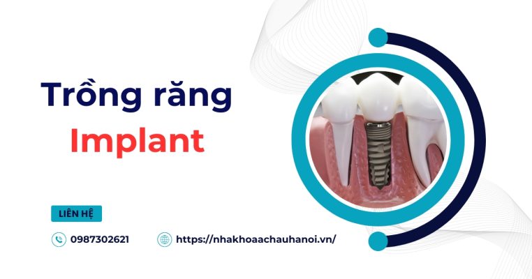 Trồng răng implant