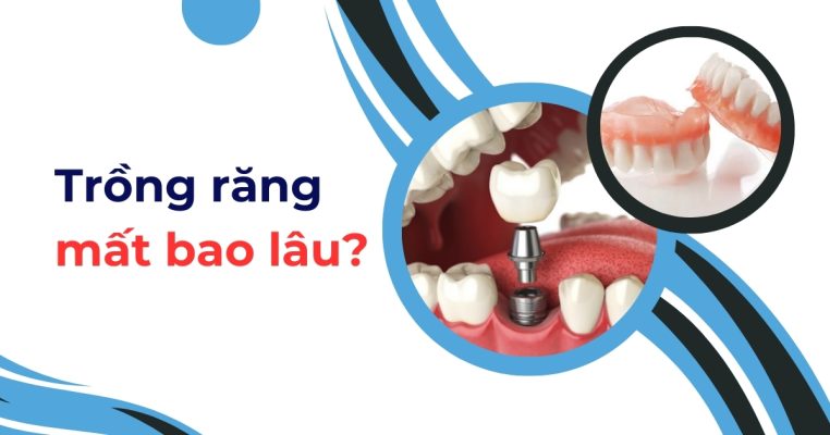 trồng răng mất bao lâu