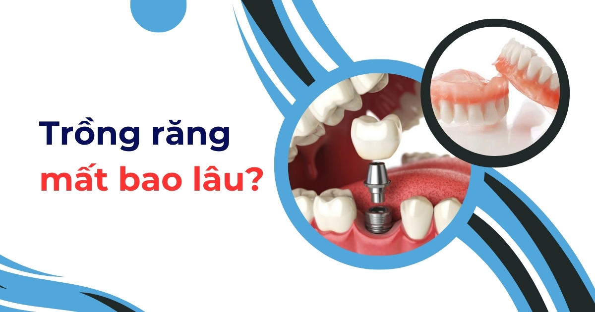 trồng răng mất bao lâu